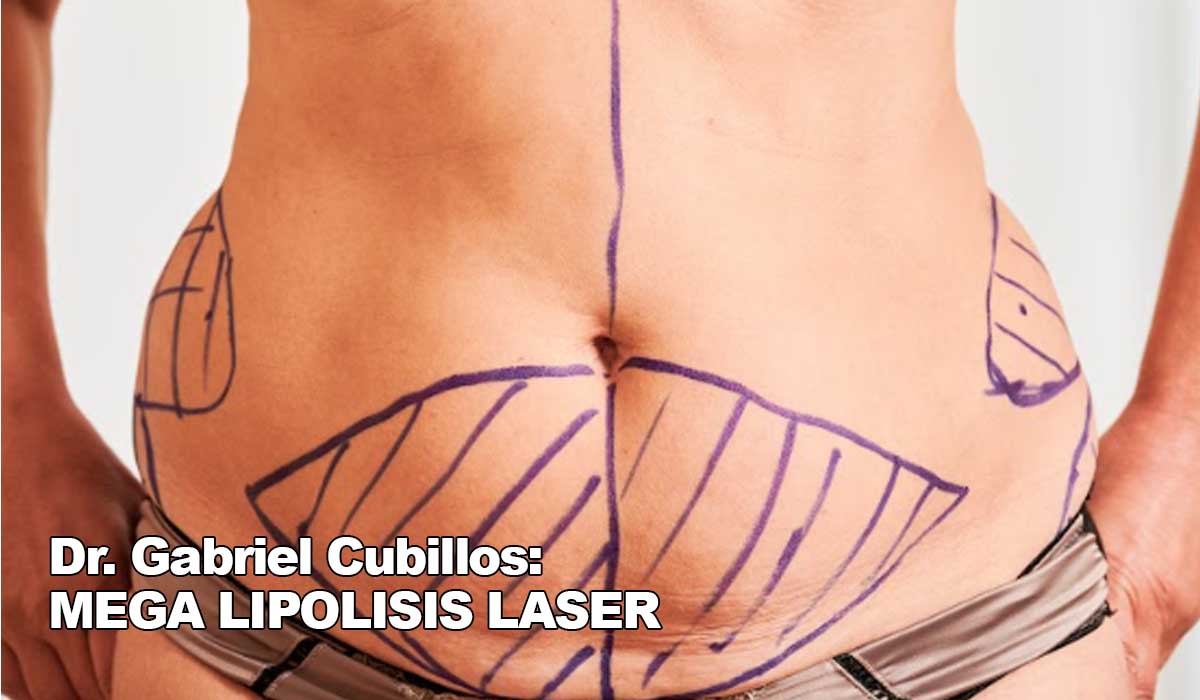 Dr Gabriel Cubillos mega lipolisis laser pexia glutea levantamiento mamario